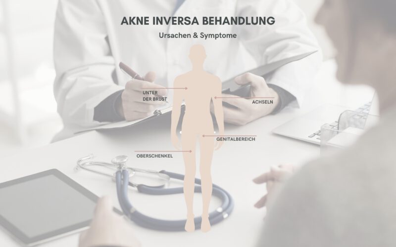 Informationsgrafik zur Akne Inversa Behandlung mit Fokus auf betroffene Körperbereiche wie Achseln, Genitalbereich, unter der Brust und Oberschenkel.
