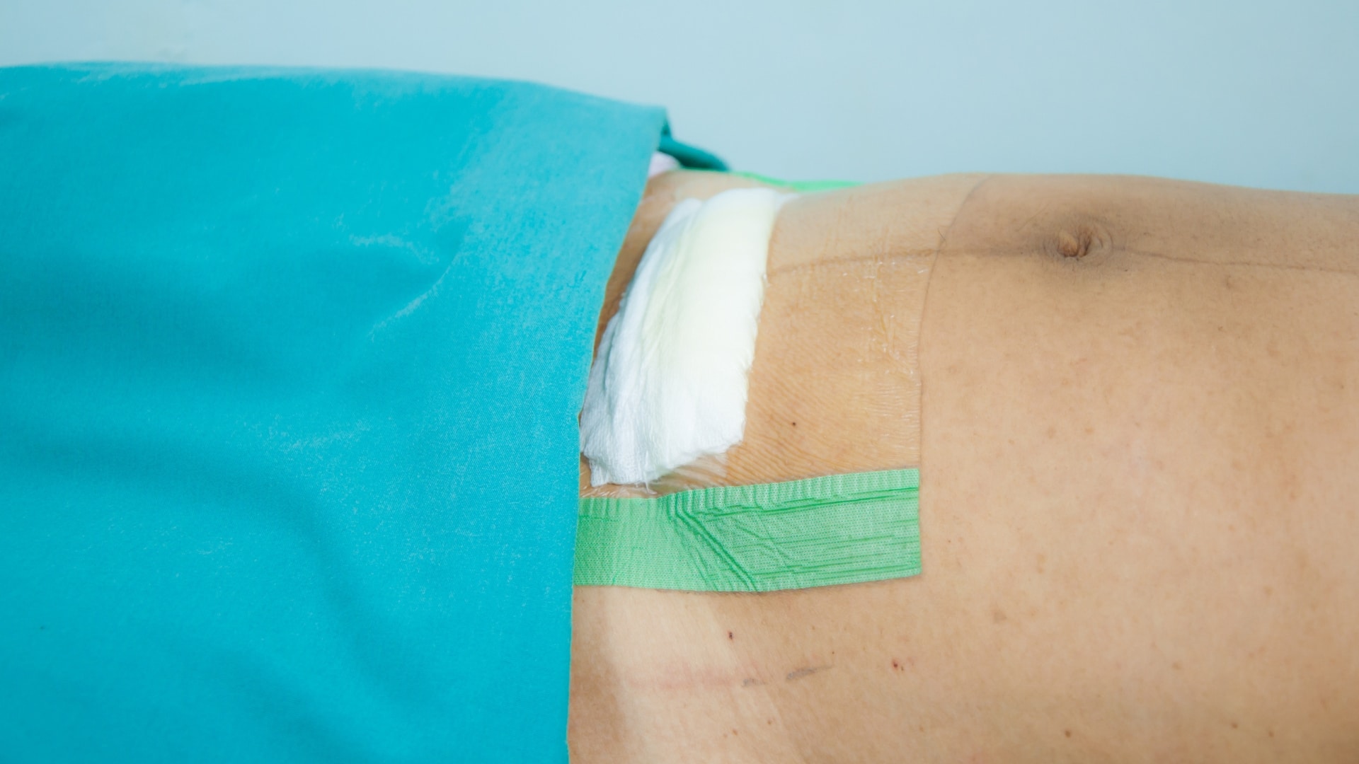 Postoperative Wundversorgung mit sterilem Verband – Wundpflege nach Akne Inversa Operation.