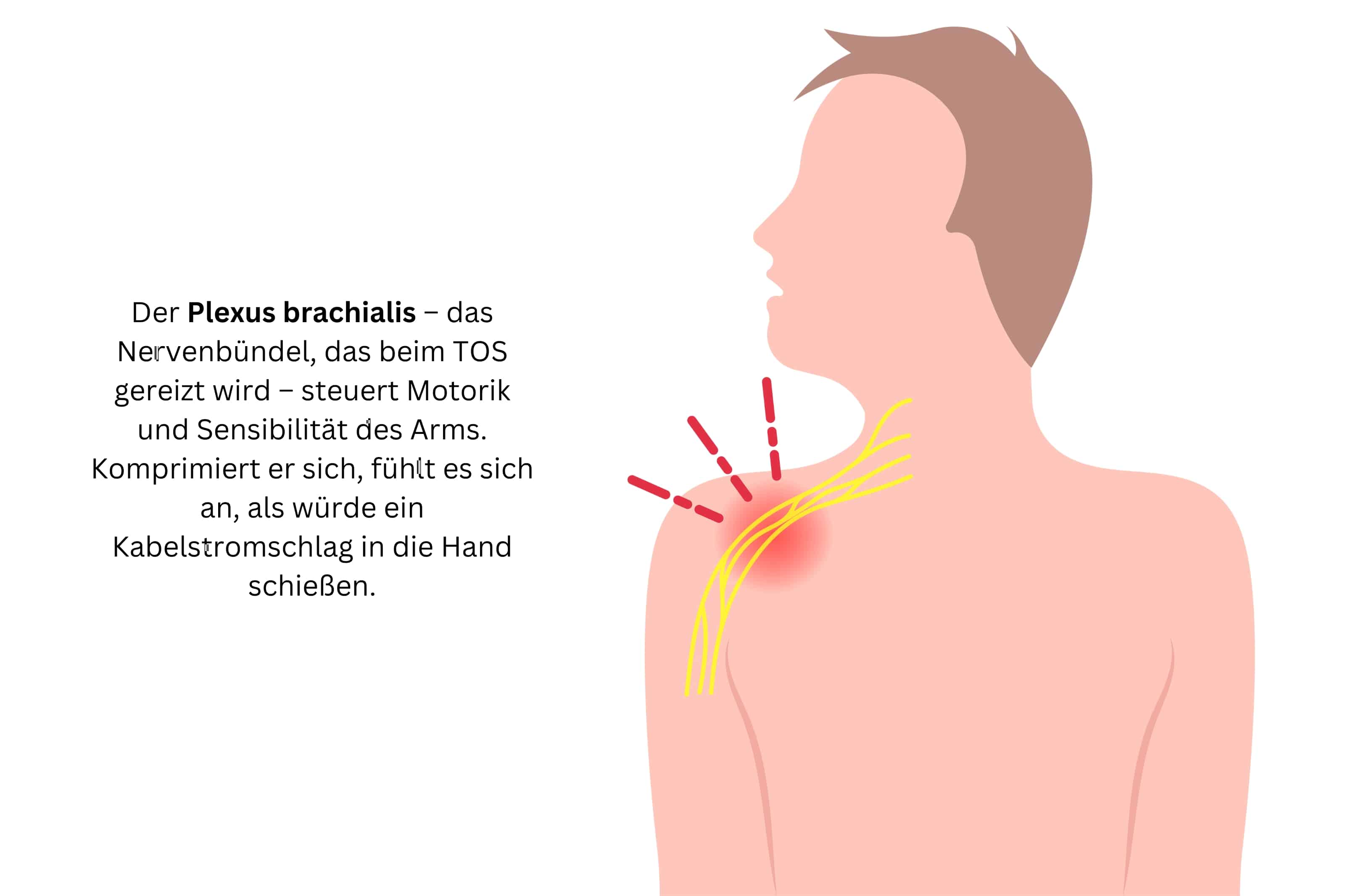 Illustration des Plexus brachialis, dem Nervengeflecht, das beim Thorakalen Outlet Syndrom (TOS) betroffen ist. Darstellung der Nervenbahnen und Schmerzbereiche in der Schulterregion.